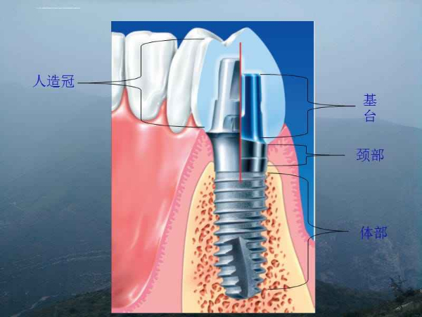 合肥种植一颗牙齿大概多少钱_集采后多少钱？